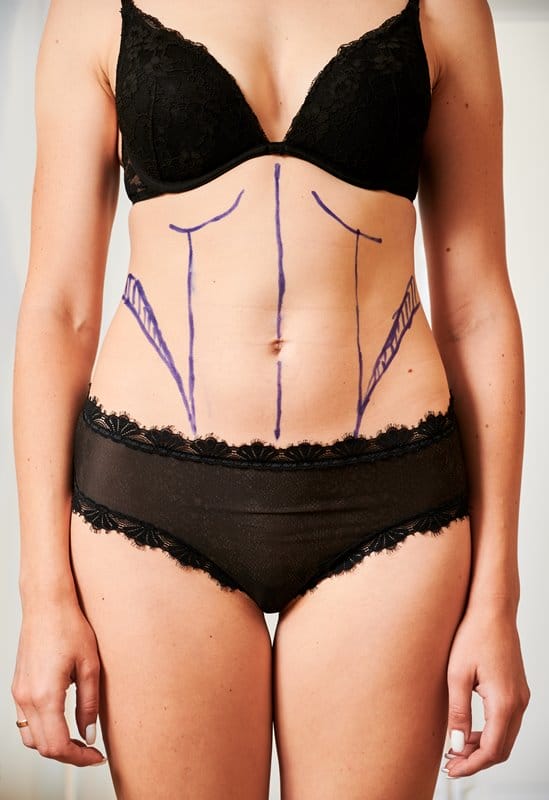 Female patient body with marks for plastic surgery.
